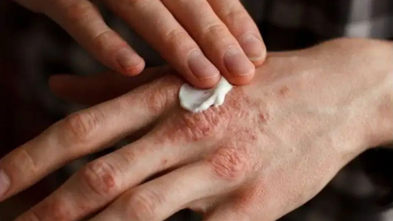 Skin Care: ਗਰਮੀਆਂ ‘ਚ ਤੇਜ਼ੀ ਨਾਲ ਫੈਲਦੀ ਹੈ ਚੰਬਲ (Eczema) ਦੀ ਬਿਮਾਰੀ, ਇਸ ਤਰ੍ਹਾਂ ਕਰੋ ਬਚਾਅ Skin Care: ਗਰਮੀਆਂ ‘ਚ ਤੇਜ਼ੀ ਨਾਲ ਫੈਲਦੀ ਹੈ ਚੰਬਲ (Eczema) ਦੀ ਬਿਮਾਰੀ, ਇਸ ਤਰ੍ਹਾਂ ਕਰੋ ਬਚਾਅ