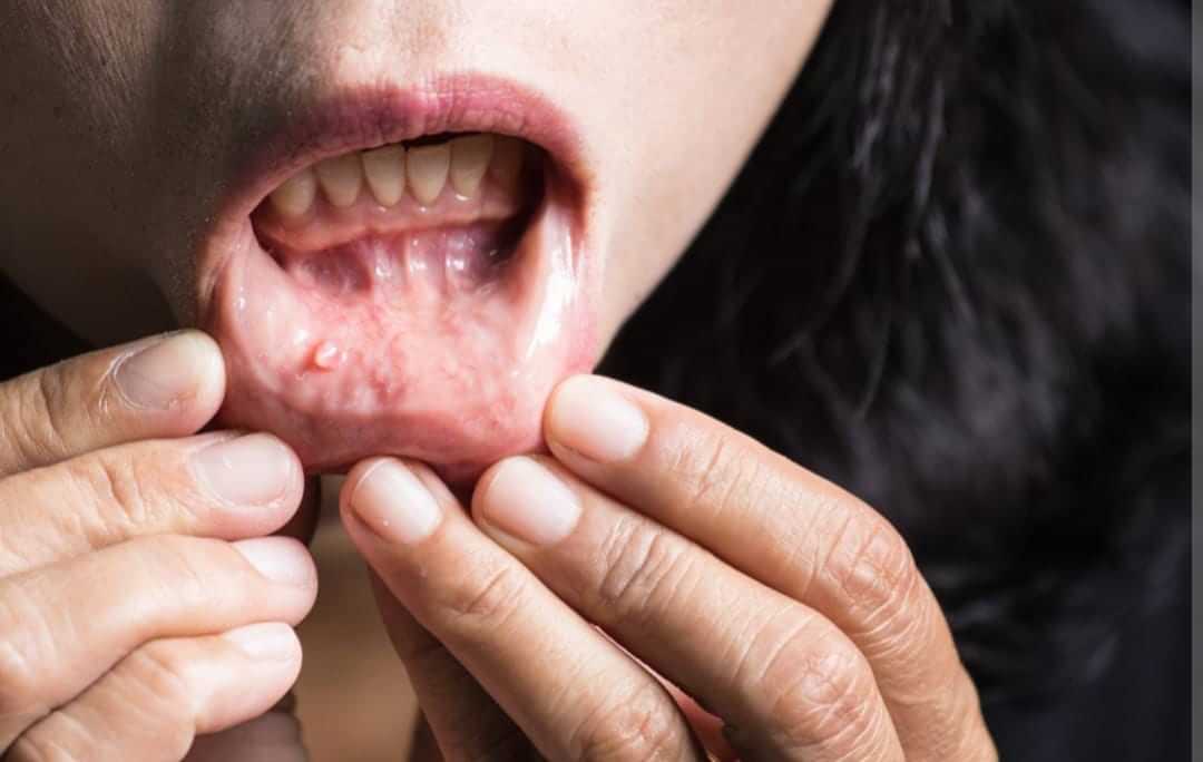 Oral Cancer : ਭਾਰਤ ਚ ਤੇਜ਼ੀ ਨਾਲ ਵੱਧ ਰਹੇ ਹਨ ਮੂੰਹ ਦੇ ਕੈਂਸਰ ਦੇ ਮਰੀਜ਼