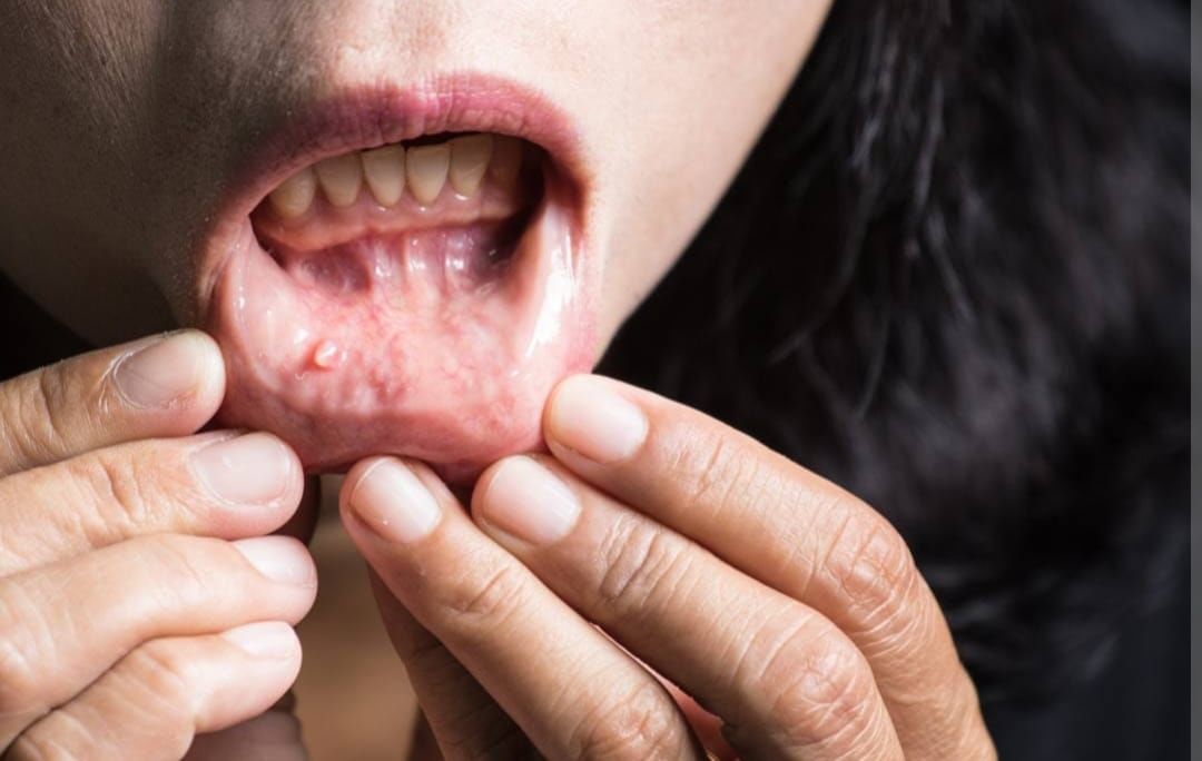 Oral Cancer : ਭਾਰਤ ‘ਚ ਤੇਜ਼ੀ ਨਾਲ ਵੱਧ ਰਹੇ ਹਨ ਮੂੰਹ ਦੇ ਕੈਂਸਰ ਦੇ ਮਰੀਜ਼ Oral Cancer : ਭਾਰਤ ‘ਚ ਤੇਜ਼ੀ ਨਾਲ ਵੱਧ ਰਹੇ ਹਨ ਮੂੰਹ ਦੇ ਕੈਂਸਰ ਦੇ ਮਰੀਜ਼