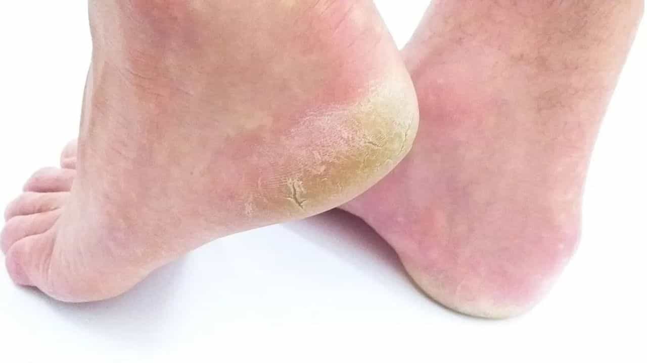 Health Tips: ਅੱਡੀਆਂ ਫੱਟਣ ਦਾ ਹੈਲਥ ਨਾਲ ਕੀ ਕੁਨੈਕਸ਼ਨ? ਐਕਸਪਰਟ ਤੋਂ ਜਾਣੋ