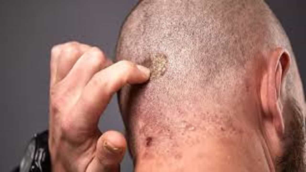 ਕੀ ਤੁਹਾਡੇ ਵੀ ਸਿਰ ਤੇ ਵਾਰ-ਵਾਰ ਹੁੰਦੀ ਹੈ ਫਿਣਸੀ, ਇਸ ਬਿਮਾਰੀ ਦਾ ਹੈ ਲੱਛਣ ?