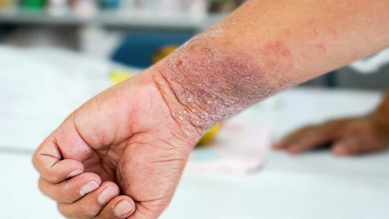 Fungal Infection : ਗਰਮੀਆਂ ਵਿੱਚ ਕਿਉਂ ਹੁੰਦਾ ਹੈ ਫੰਗਲ ਇਨਫੈਕਸ਼ਨ, ਕਿਵੇਂ ਕਰੀਏ ਬਚਾਅ Fungal Infection : ਗਰਮੀਆਂ ਵਿੱਚ ਕਿਉਂ ਹੁੰਦਾ ਹੈ ਫੰਗਲ ਇਨਫੈਕਸ਼ਨ, ਕਿਵੇਂ ਕਰੀਏ ਬਚਾਅ