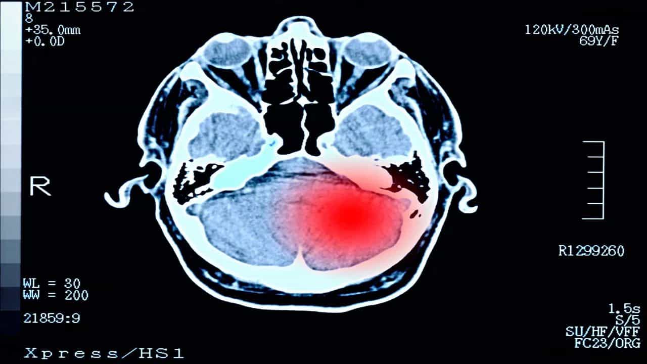 ਬ੍ਰੇਨ ਟਿਊਮਰ ਕਿਉਂ ਹੁੰਦਾ ਹੈ, ਕਿਵੇਂ ਦਿਖਾਈ ਦਿੰਦੇ ਹਨ ਇਸ ਦੇ ਸ਼ੁਰੂਆਤੀ ਲੱਛਣ?