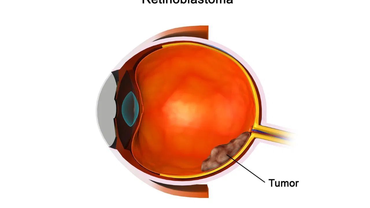 Retinoblastoma