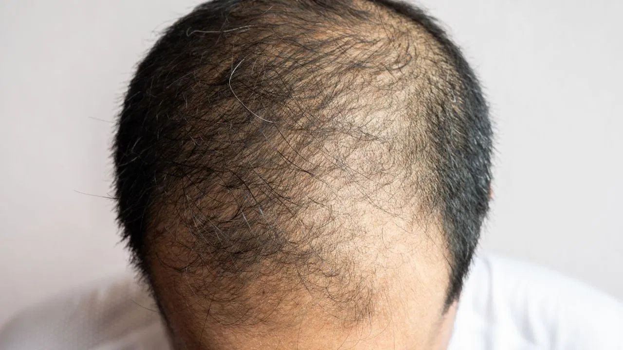 hair Loss