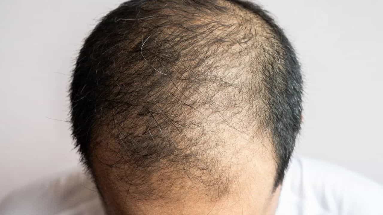 Health Tips: ਔਰਤਾਂ ਦੇ ਮੁਕਾਬਲੇ ਮਰਦਾਂ ਚ ਗੰਜਾਪਨ ਜ਼ਿਆਦਾ ਕਿਉਂ ਹੁੰਦਾ ਹੈ? ਕੀ ਹਨ ਕਾਰਨ? Health Tips: ਔਰਤਾਂ ਦੇ ਮੁਕਾਬਲੇ ਮਰਦਾਂ ਚ ਗੰਜਾਪਨ ਜ਼ਿਆਦਾ ਕਿਉਂ ਹੁੰਦਾ ਹੈ? ਕੀ ਹਨ ਕਾਰਨ?