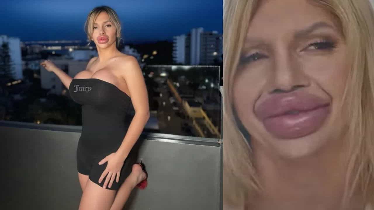 ਇਸ ਔਰਤ ਦੇ ਸਰੀਰ ਵਿੱਚ ਚਰਬੀ ਤੋਂ ਵੱਧ ਪਲਾਸਟਿਕ ਹੈ, 40 ਲੱਖ ਖਰਚ ਮੋਮੋ ਵਰਗੇ ਬਣਾਏ ਆਪਣੇ ਬੁੱਲ੍ਹ ਇਸ ਔਰਤ ਦੇ ਸਰੀਰ ਵਿੱਚ ਚਰਬੀ ਤੋਂ ਵੱਧ ਪਲਾਸਟਿਕ ਹੈ, 40 ਲੱਖ ਖਰਚ ਮੋਮੋ ਵਰਗੇ ਬਣਾਏ ਆਪਣੇ ਬੁੱਲ੍ਹ