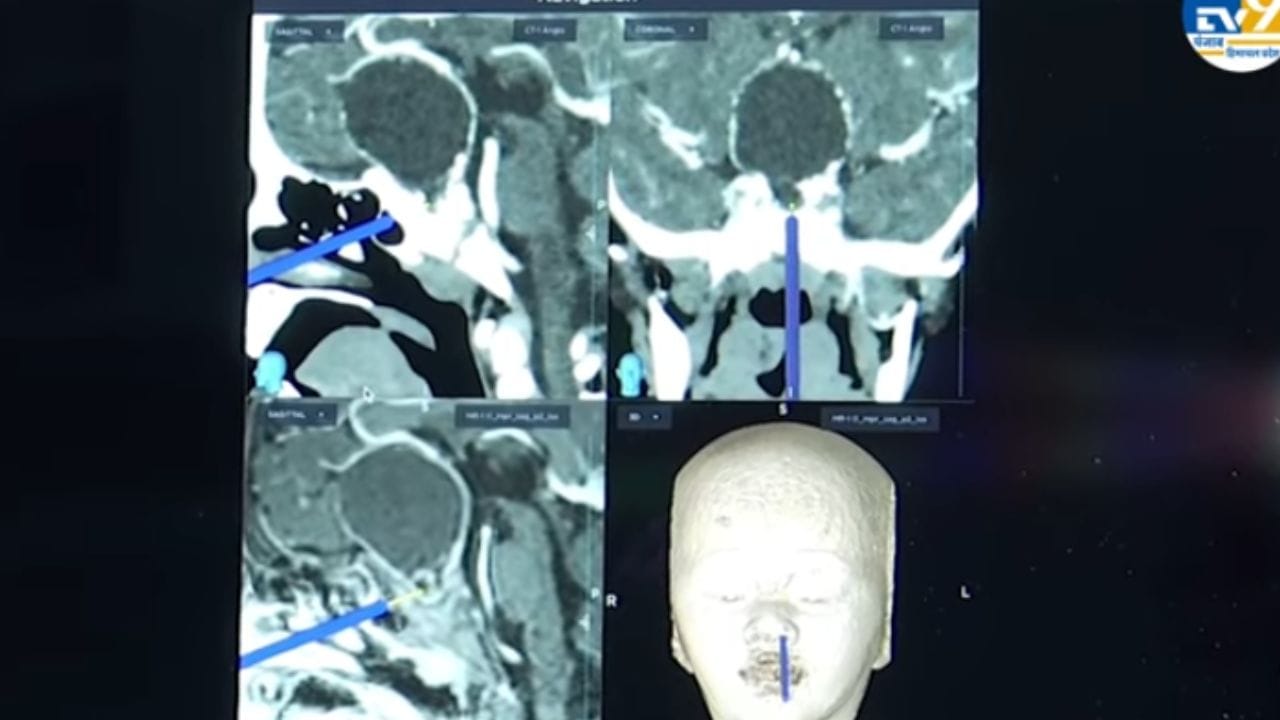 ਚੰਡੀਗੜ੍ਹ ਪੀਜੀਆਈ ਦੇ ਡਾਕਟਰਾਂ ਦਾ ਕਮਾਲ, ਬਿਨਾ ਚੀਰਾ ਲਗਾਏ 2 ਸਾਲ ਦੀ ਬੱਚੀ ਦੇ ਦਿਮਾਗ ਵਿੱਚੋਂ ਕੱਢਿਆ ਟਿਊਮਰ