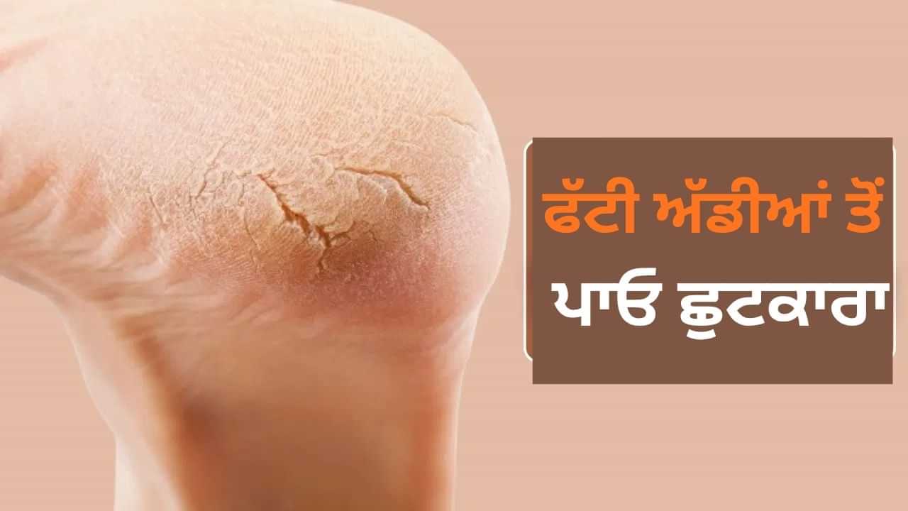 ਮਹਿੰਗੀ ਕ੍ਰੀਮ ਦੀ ਨਹੀਂ ਪਵੇਗੀ ਜ਼ਰੂਰਤ, ਕਰੋ ਇਹ ਉਪਾਅ ਅੱਡੀਆਂ ਹੋ ਜਾਣਗੀਆਂ ਨਰਮ