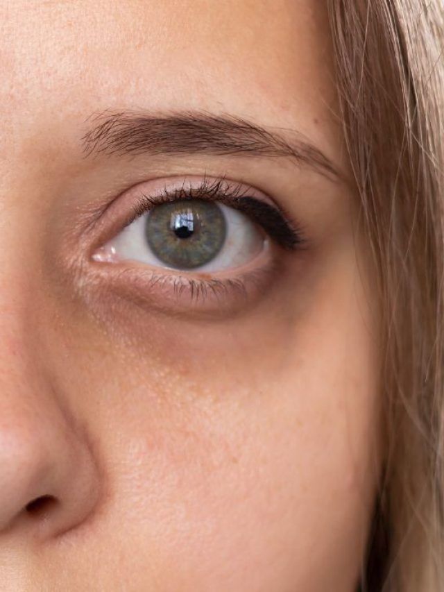 ਦੇਰ ਤੱਕ ਜਾਗਣ ਨਾਲ ਹੀ ਨਹੀਂ, ਸਗੋਂ ਇਨ੍ਹਾਂ ਕਾਰਨਾਂ ਕਰਕੇ ਵੀ ਹੁੰਦੇ ਹਨ Dark Circle