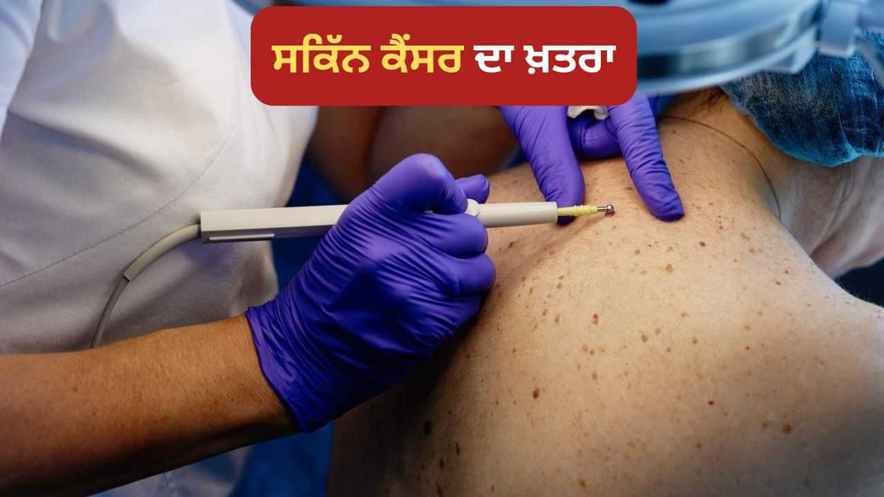 ਸਕਿੱਨ ਕੈਂਸਰ ਦਾ ਕਿਸ ਨੂੰ ਹੁੰਦਾ ਹੈ ਖ਼ਤਰਾ, ਕੀ ਹੁੰਦੇ ਹਨ ਇਹਦੇ ਲੱਛਣ ? ਸਕਿੱਨ ਕੈਂਸਰ ਦਾ ਕਿਸ ਨੂੰ ਹੁੰਦਾ ਹੈ ਖ਼ਤਰਾ, ਕੀ ਹੁੰਦੇ ਹਨ ਇਹਦੇ ਲੱਛਣ ?