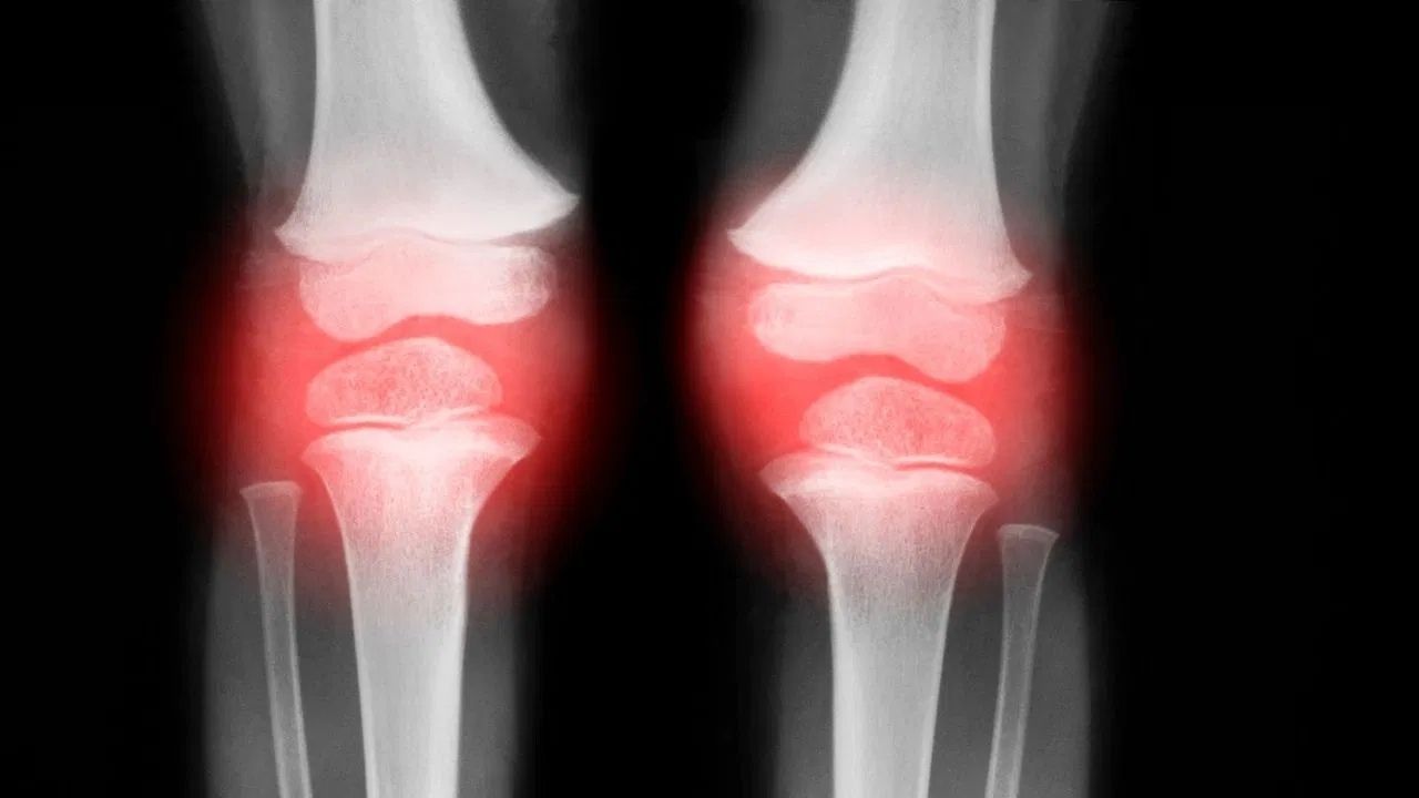 ਕਮਜ਼ੋਰ ਹੱਡੀਆਂ ਦਾ ਕੀ ਹੈ ਕਾਰਨ? ਐਕਸਪਰਟ ਤੋਂ ਜਾਣੋ