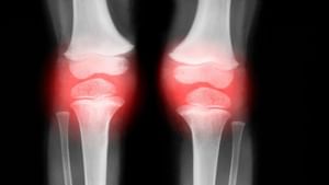 ਕਮਜ਼ੋਰ ਹੱਡੀਆਂ ਦਾ ਕੀ ਹੈ ਕਾਰਨ? ਐਕਸਪਰਟ ਤੋਂ ਜਾਣੋ ਕਮਜ਼ੋਰ ਹੱਡੀਆਂ ਦਾ ਕੀ ਹੈ ਕਾਰਨ? ਐਕਸਪਰਟ ਤੋਂ ਜਾਣੋ