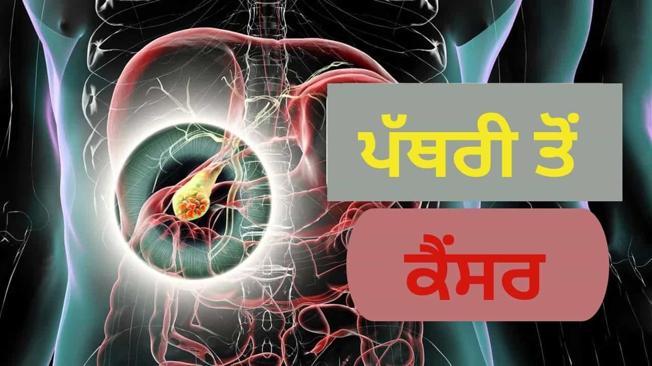 Gallbladder ਦਾ ਸਟੋਨ ਬਣ ਸਕਦਾ ਹੈ ਮੌਤ ਦਾ ਕਾਰਨ, ਡਾਕਟਰ ਨੇ ਦੱਸਿਆ ਕਦੋਂ ਹੈ ਲਾਇਲਾਜ Gallbladder ਦਾ ਸਟੋਨ ਬਣ ਸਕਦਾ ਹੈ ਮੌਤ ਦਾ ਕਾਰਨ, ਡਾਕਟਰ ਨੇ ਦੱਸਿਆ ਕਦੋਂ ਹੈ ਲਾਇਲਾਜ