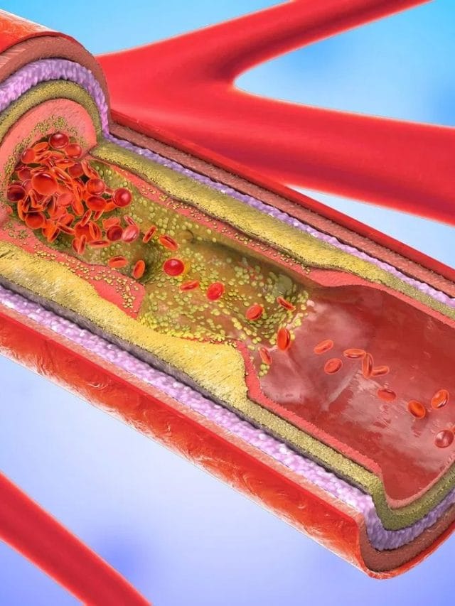 Bad ਕੋਲੈਸਟ੍ਰੋਲ ਕਿਵੇਂ ਵਧਦਾ ਹੈ, ਇਸ ਨੂੰ ਕਿਵੇਂ ਕੰਟ੍ਰੋਲ ਕੀਤਾ ਜਾਵੇ