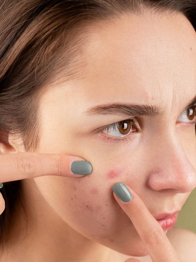 ਕੀ Oily ਖਾਣ ਕਾਰਨ ਪਿੰਪਲਸ ਹੋ ਸਕਦੇ ਹਨ?