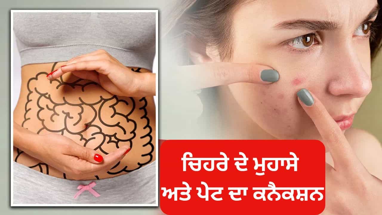 ਚਿਹਰੇ ਦੇ ਮੁਹਾਸੇ ਅਤੇ ਪੇਟ ਦੇ ਵਿਚਕਾਰ ਕੀ ਹੈ ਕਨੈਕਸ਼ਨ, ਆਯੁਰਵੈਦਿਕ ਮਾਹਰ ਤੋਂ ਸਮਝੋ