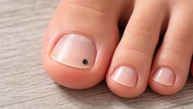 ਨਹੁੰਆਂ 'ਤੇ ਤਿਲ, ਜਾਣੋ ਸਾਮੁਦਰਿਕ ਸ਼ਾਸਤਰ ਅਨੁਸਾਰ ਇਹ ਸ਼ੁਭ ਹੈ ਜਾਂ ਅਸ਼ੁਭ