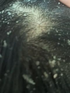 ਇਨ੍ਹਾਂ 2 ਤੱਤਾਂ ਦਾ ਰਸ ਕਰੇਗਾ ਡੈਂਡਰਫ ਨੂੰ ਖਤਮ, ਇਸ ਤਰ੍ਹਾਂ ਕਰੋ ਵਰਤੋਂ...