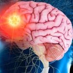 ਬ੍ਰੇਨ ਸਟ੍ਰੋਕ ਕਿਉਂ ਆਉਂਦਾ ਹੈ? ਲੱਛਣ ਦਿਖਣ ‘ਤੇ ਸਭ ਤੋਂ ਪਹਿਲਾਂ ਕੀ ਕਰੀਏ