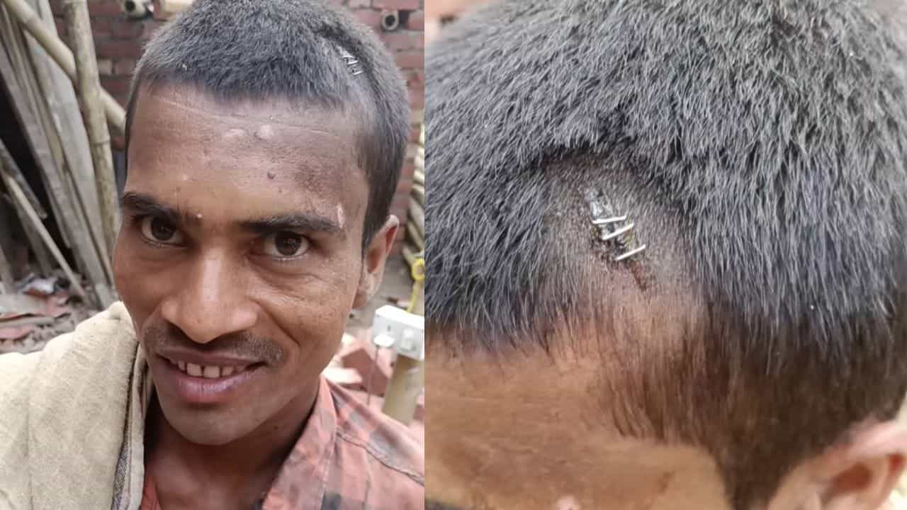 Viral Video: ਬੰਦੇ ਦਾ ਸਿਰ ਫਟਿਆ ਤਾਂ ਡਾਕਟਰ ਨੇ ਟਾਂਕਿਆਂ ਦੀ ਬਜਾਏ ਲਗਾਏ ਸਟੈਪਲਰ ਪਿੰਨ, ਵੀਡੀਓ ਹੋਇਆ ਵਾਇਰਲ